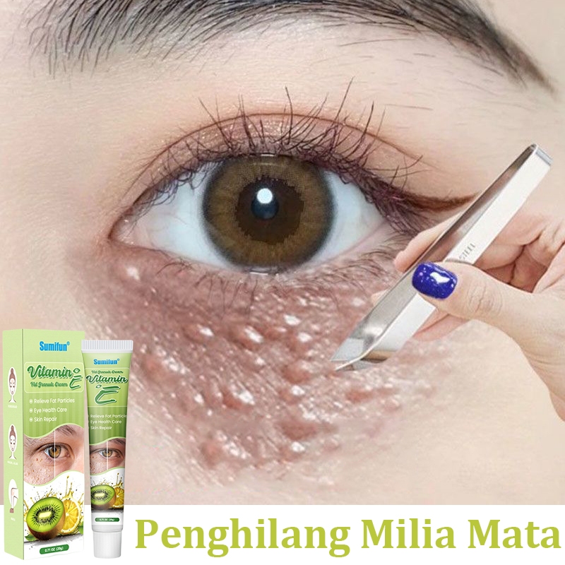 krim penghilang milia syringoma xanthelasma butiran lemak sekitar mata