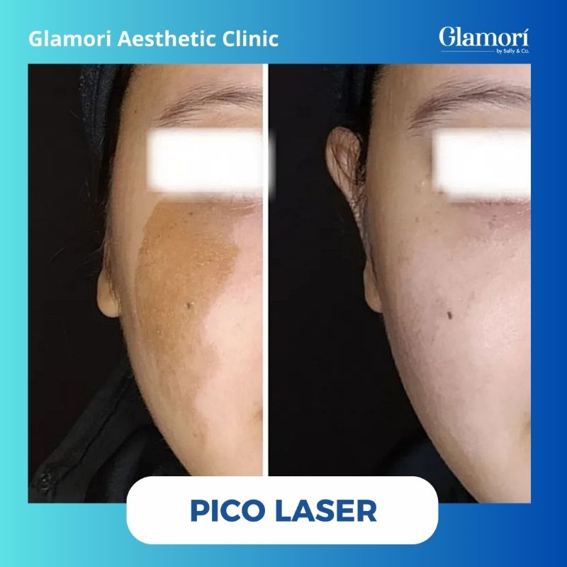 PICO LASER TREATMENT//FLEK HITAM//BEKAS JERAWAT//TATTOO DLL
