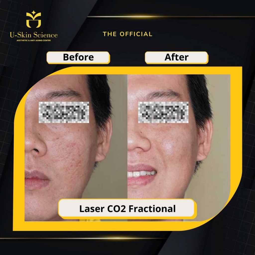 {Uskin} Laser CO2 Fractional