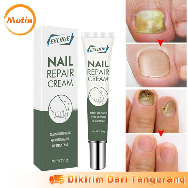 Obat Jamur Kuku Kaki Krim Kaki Jempol Kaki Perawatan Nail Repair Cream