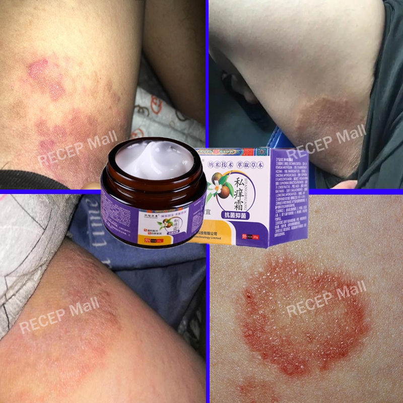 obat gatal selangkangan salep gatal paling ampuh cream selangkangan gatal dan hitam salap gatal kuli