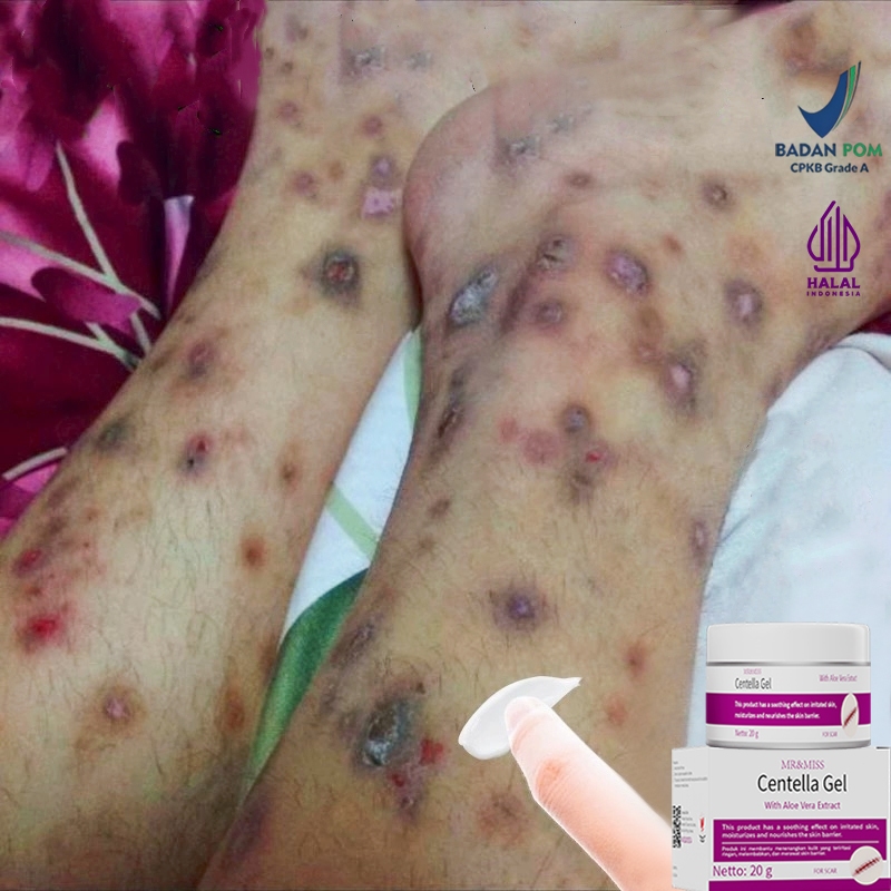 Penghilang bekas luka hitam koreng penghilang bekas luka anak salep penghilang bekas luka obat