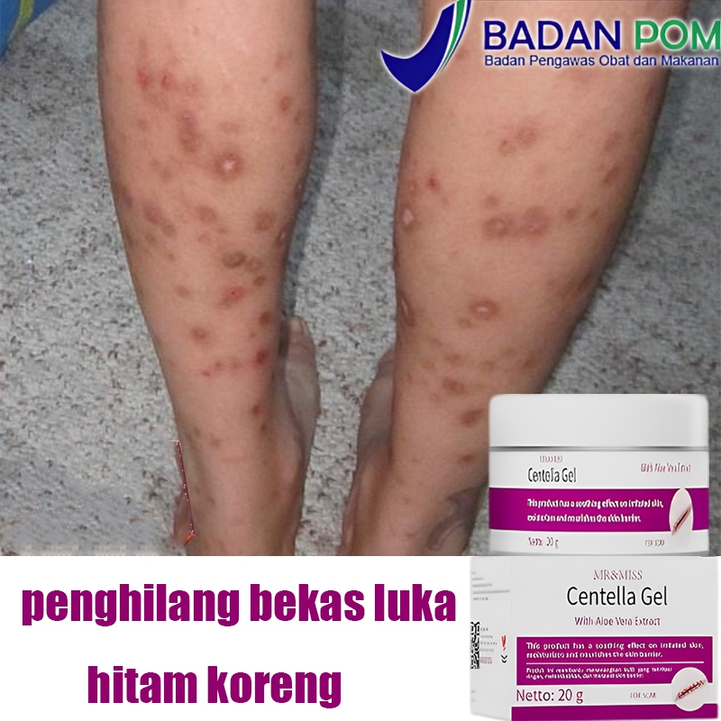Obat penghilang bekas luka menghilangkan bekas luka salep penghilang bekas luka penghilang bekas luk