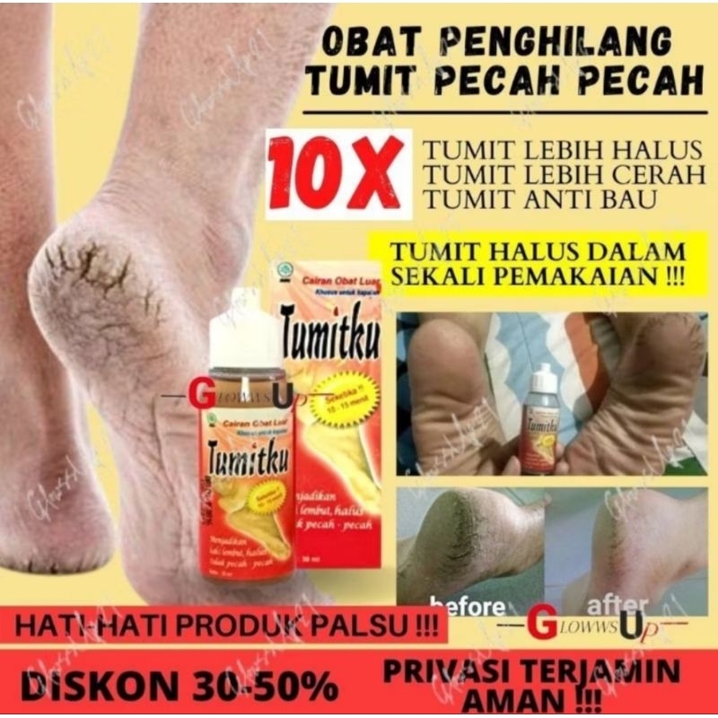 OBAT PENGHILANG TUMIT KAKI PECAH PECAH / OBAT TUMITKU ORIGINAL PALING AMPUH