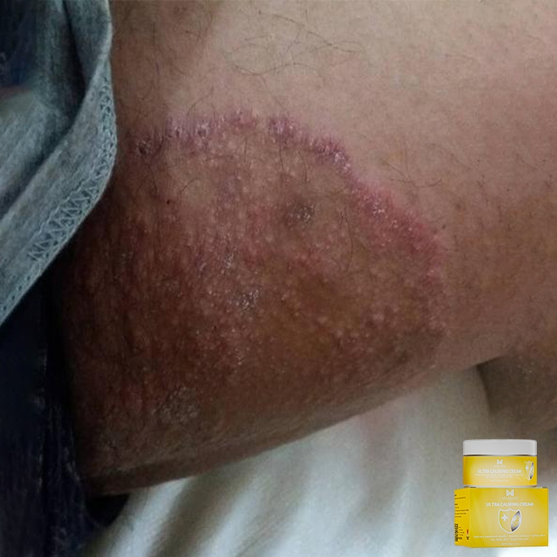 Obat gatal salep gatal selangkangan salep gatal china paling ampuh salep eksim kering paling ampuh 2
