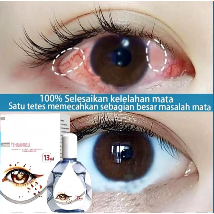 Obat Sakit Tetes Mata Kering 100% Paling Ampuh Obat Mata Katarak Berlemak Buram Kabur Bengkak