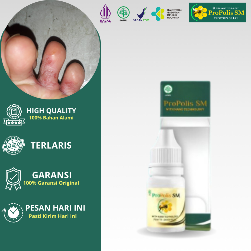 Obat Kutu Air Pada Sela Jari kaki Gatal Parah Di Tangan Penghilang Kutu Air Kaki Rayapan Scabies Ata