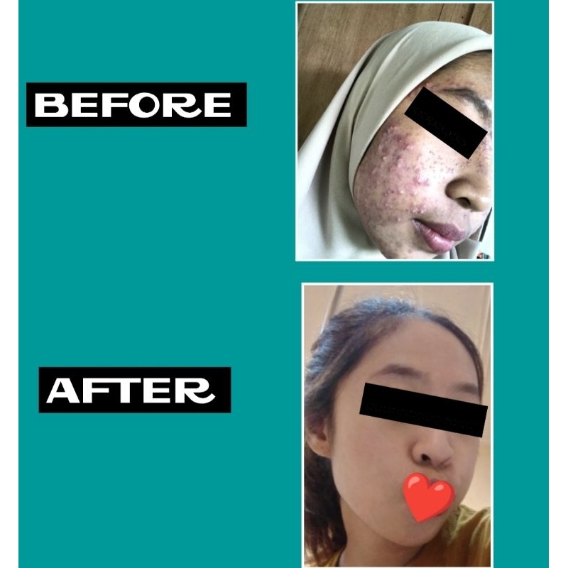 ULTYME SKINCARE ACNE / ACNE SERIES / PAKET ACNE / TONER AURA / SABUN AURA / TERMURAH / BPOM