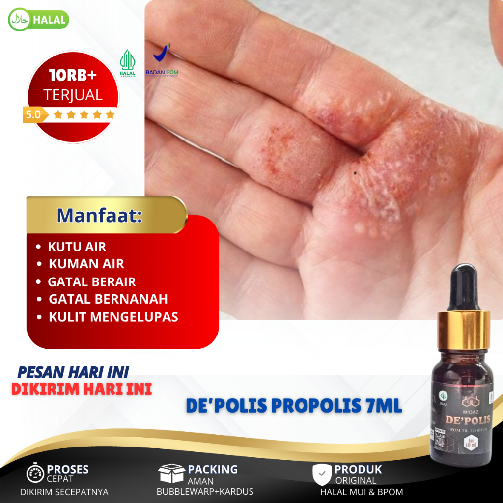 Obat Kutu Air, Obat Kutu Air Di Kaki, Obat Kutu Air Di Tangan, Obat Kutu Air di Sela Jari Kaki, Obat
