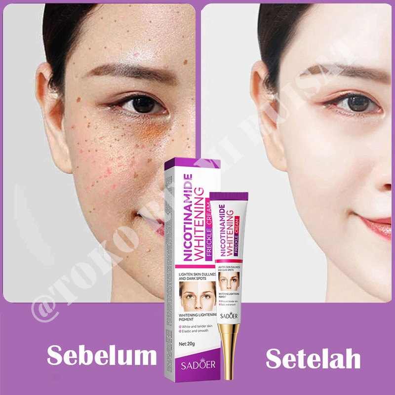 Whitening Blemish Freckle Cream Whitening Blemish chalonese - Krim Penghilang Flek Wajah - Cream Glo