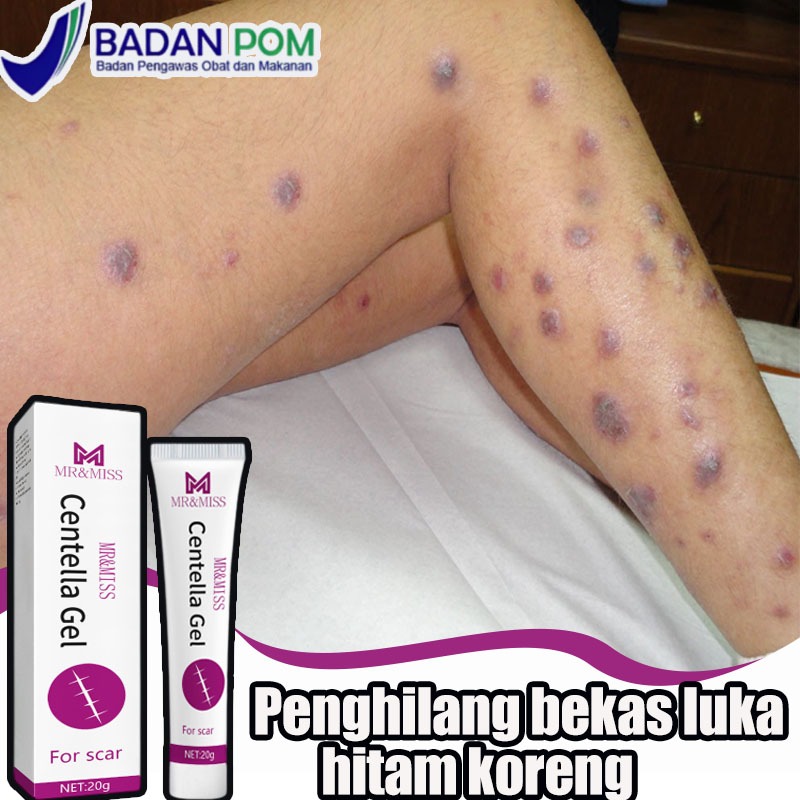 Penghilang bekas luka hitam koreng Obat penghilang bekas luka Luka obat penghilang bekas 20g Menghil