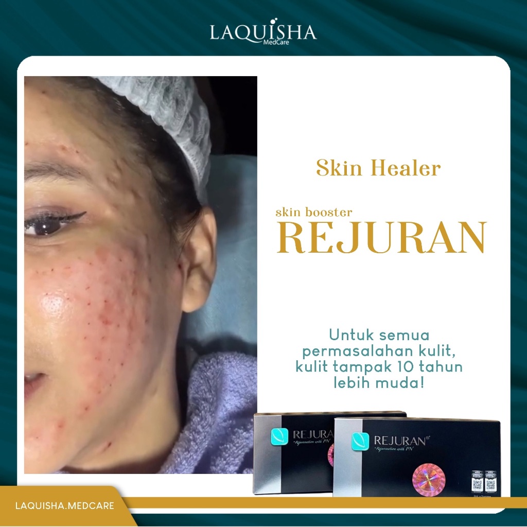 Skin booster REJUR4N