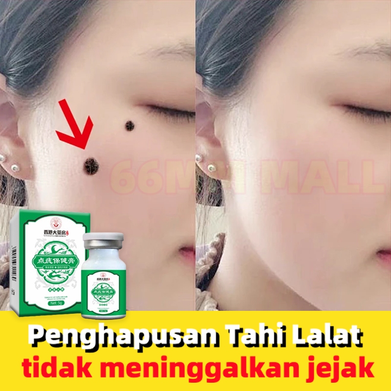 Penghilang tahi lalat Penghilang Kutil Salep penghilang tahi lalat Kutilos untuk wajah dan leher Pen