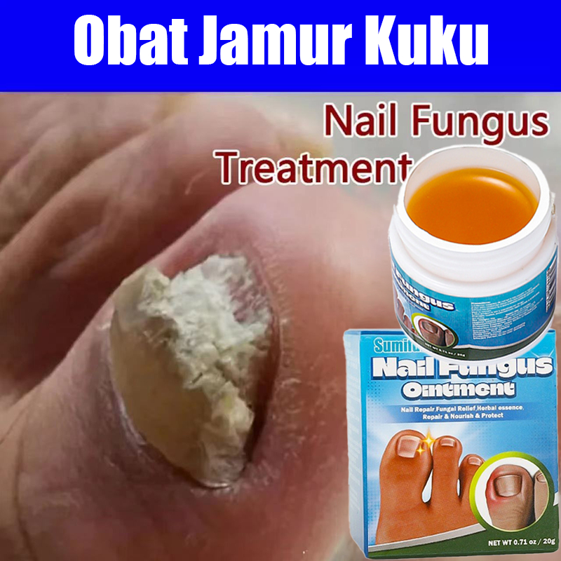 Obat Jamur Kuku Cream Jamur Kuku Obat Cantengan Salep Kuku Jamur Dan Rusak Obat Kuku Kaki Krim Kuku 