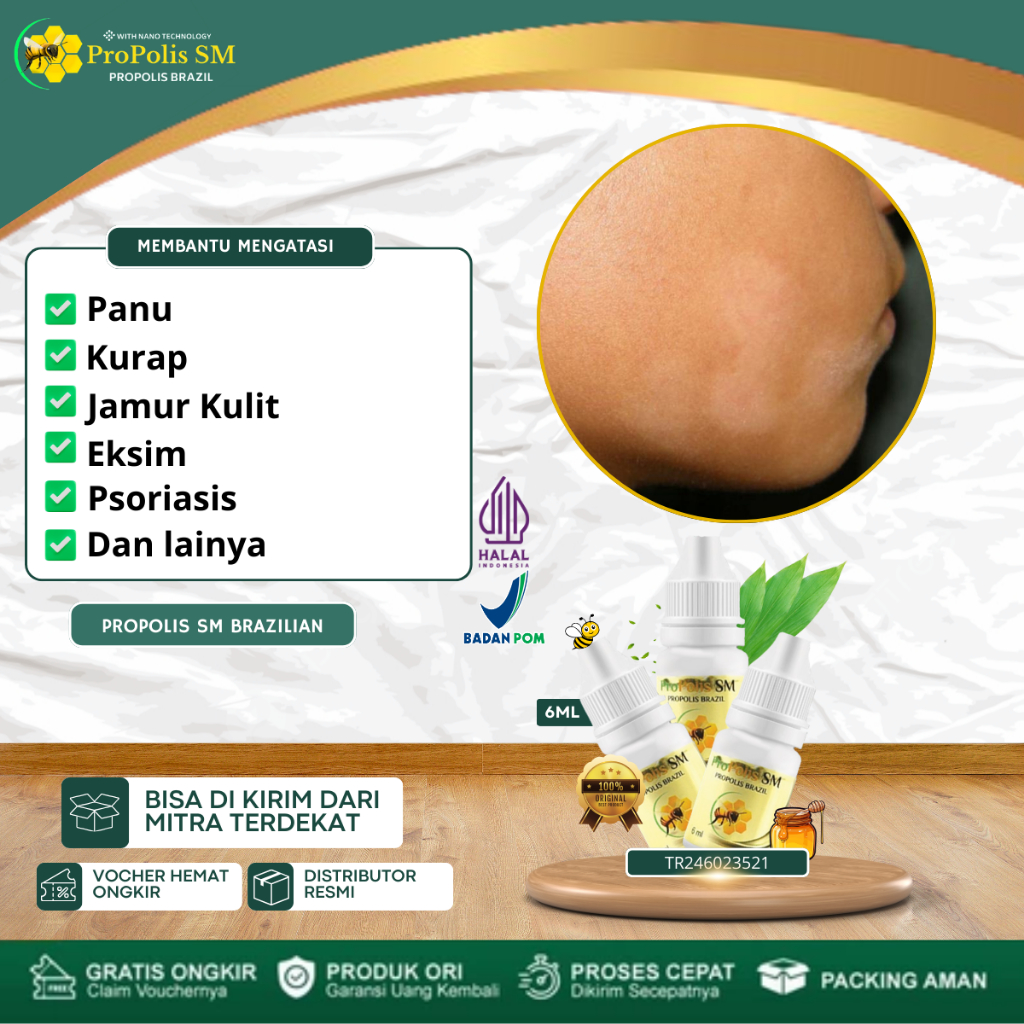 Obat Panu di Wajah Panu Menahun Hapuran Bintik Bintik Putih Di Kulit Penghilang Panu Panu Menyebar K