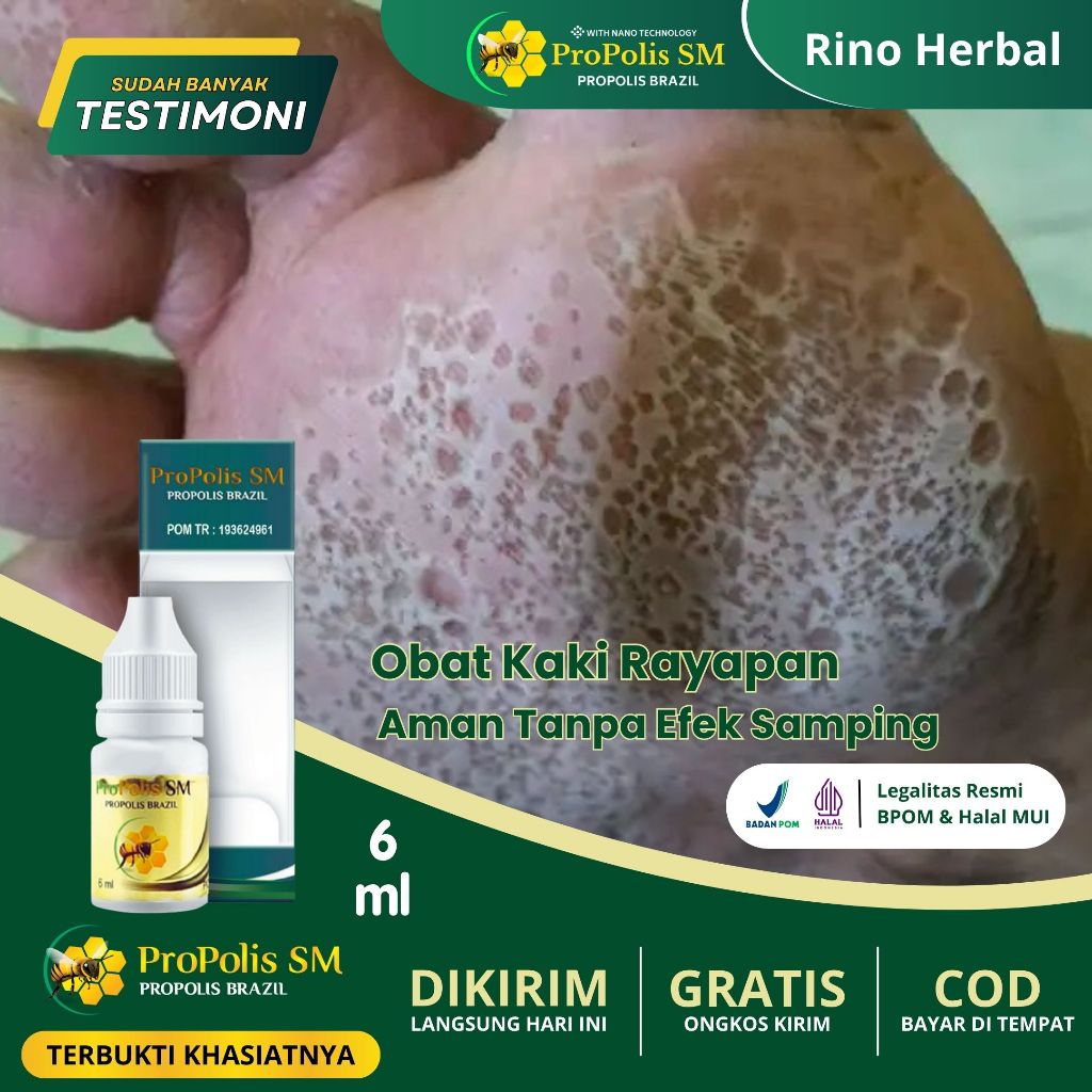Obat Kaki Rayapan dan Bau, Obat Telapak Kaki Berlubang, Obat Kaki Rayapan, Obat Telapak Kaki Rayapan