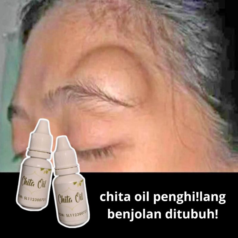PENGHILANG BENJOLAN DITUBUH, CHITA OIL OBAT OLES BENJOLAN