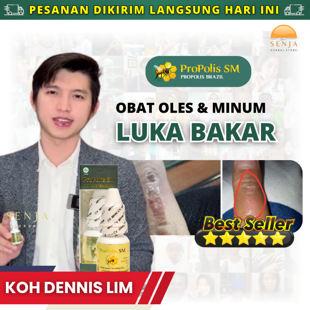 OBAT TETES PENYEMBUHAN LUKA BAKAR PANAS MELEPUH TERKENA KNALPOT AIR PANAS SEMBUH DENGAN PROPOLIS SM