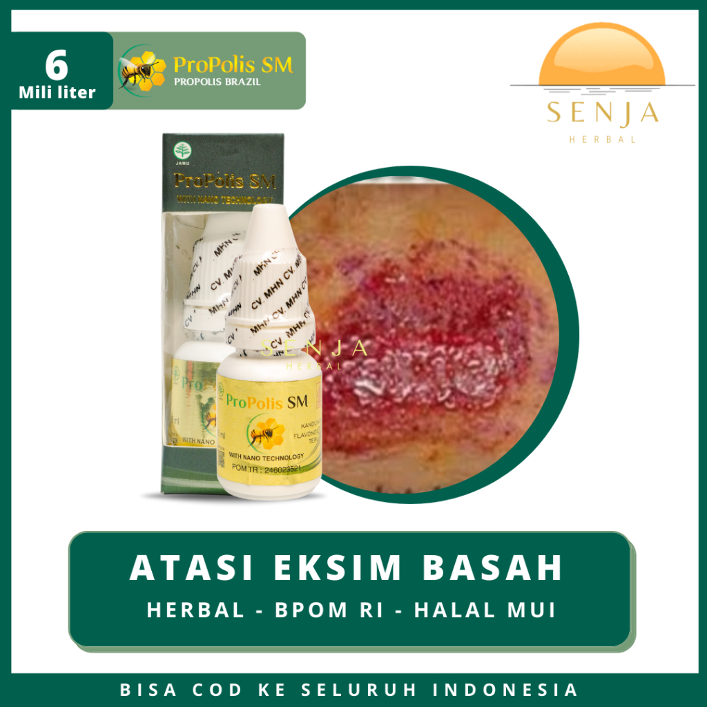 Obat Eksim Atopik, Eksim Basah, Eksim Kering, Eksim Kronis, Obat Oles Eksim [PROPOLIS SM BRAZIL]