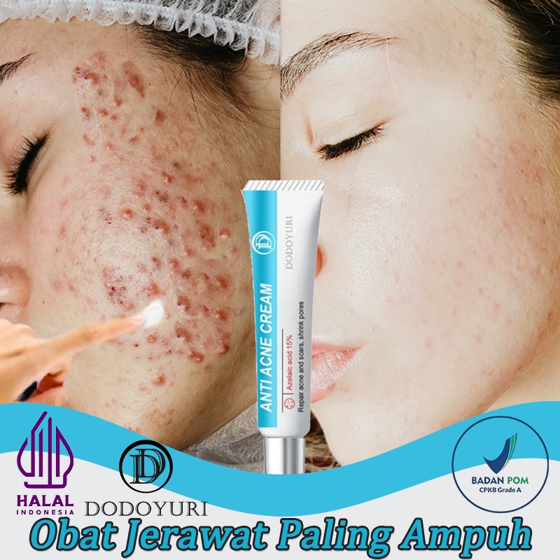 Menghilangkan bekas jerawat Salep jerawat Penghilang bekas jerawat 20ml Totol jerawat ampuh Serum je