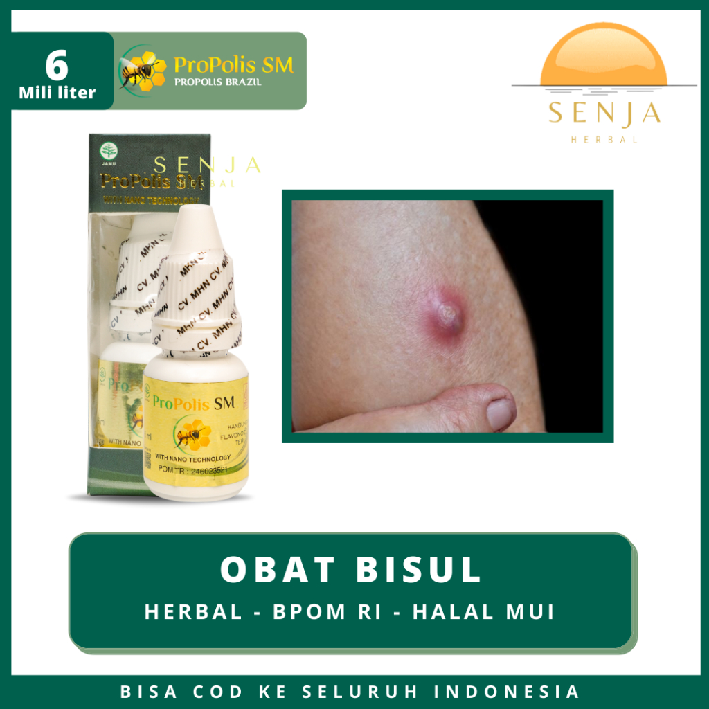 OBAT BISUL PANTAT TANGAN KETIAK BERNANAH PECAH UNTUK ANAK & DEWASA | PROPOLIS SM