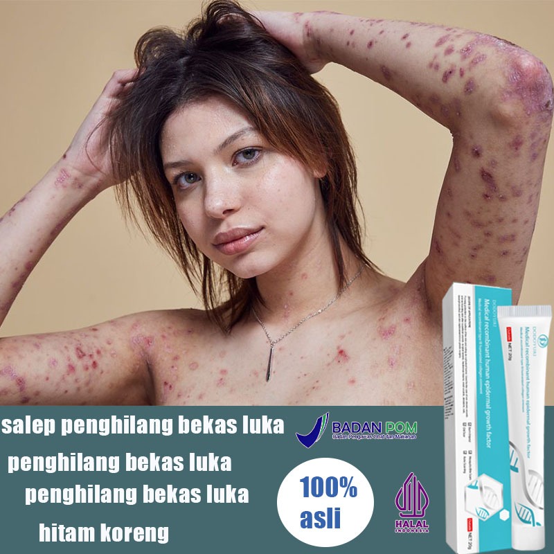 Menghilangkan bekas luka Obat penghilang bekas luka Penghilang bekas luka Salep penghilang bekas luk