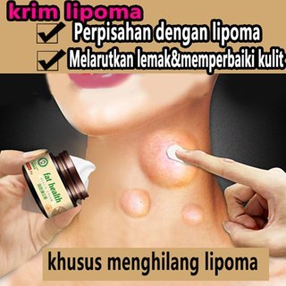 Cream Lipoma 30g Krim Lipoma obat Benjolan Benjolan Leher Tangan Ketiak Benjolan Leher Punggung Bahu