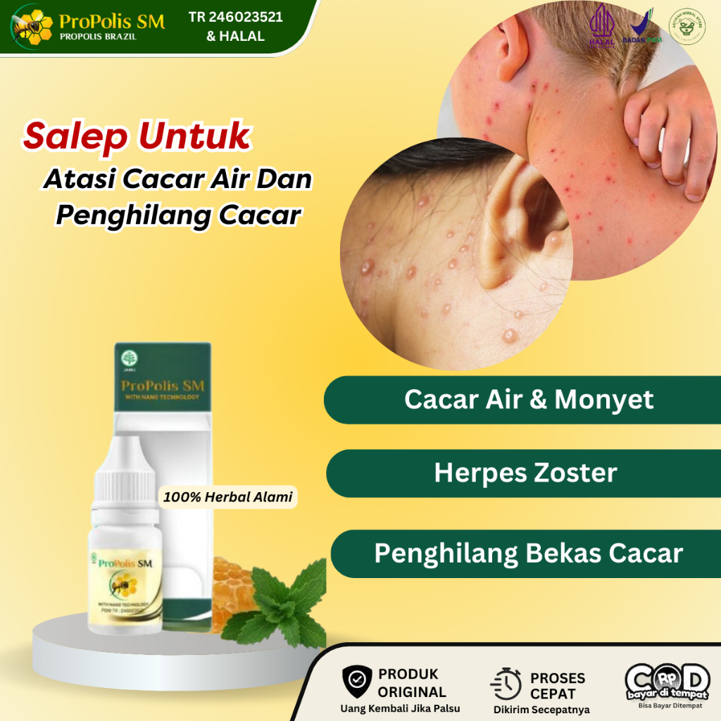 Obat Cacar Air, Obat Bintik Kecil Berair Di Tubuh, Cacar Monyet, Penghilang bekas Cacar, Gatal Berai