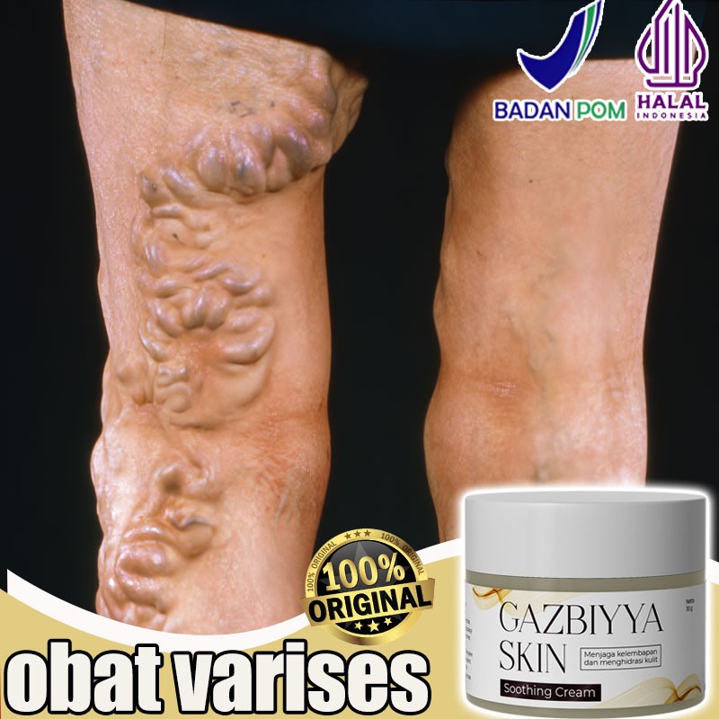 Obat varises Varicose veins cream Cream varises paling ampuh original Salep varises paling ampuh 30g