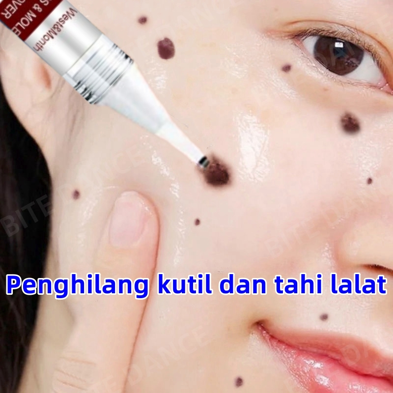 Obat penghilang tahi lalat Penghilang kutil dan tahi lalat Penghilang tahi lalat di wajah Penghilang