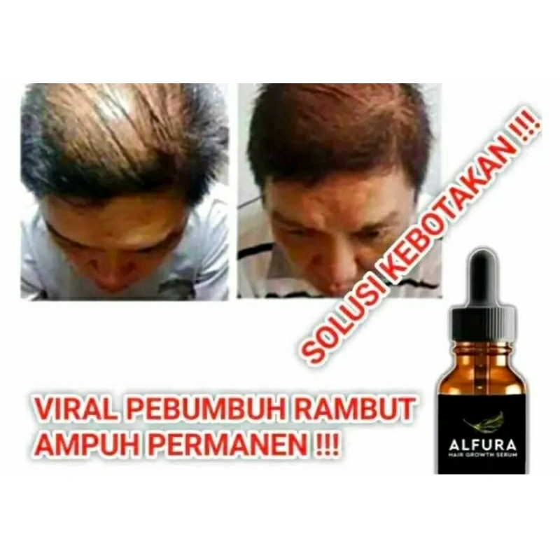 Penumbuh rambut alfura hair serum 20 ml original perawatan rambut rontok