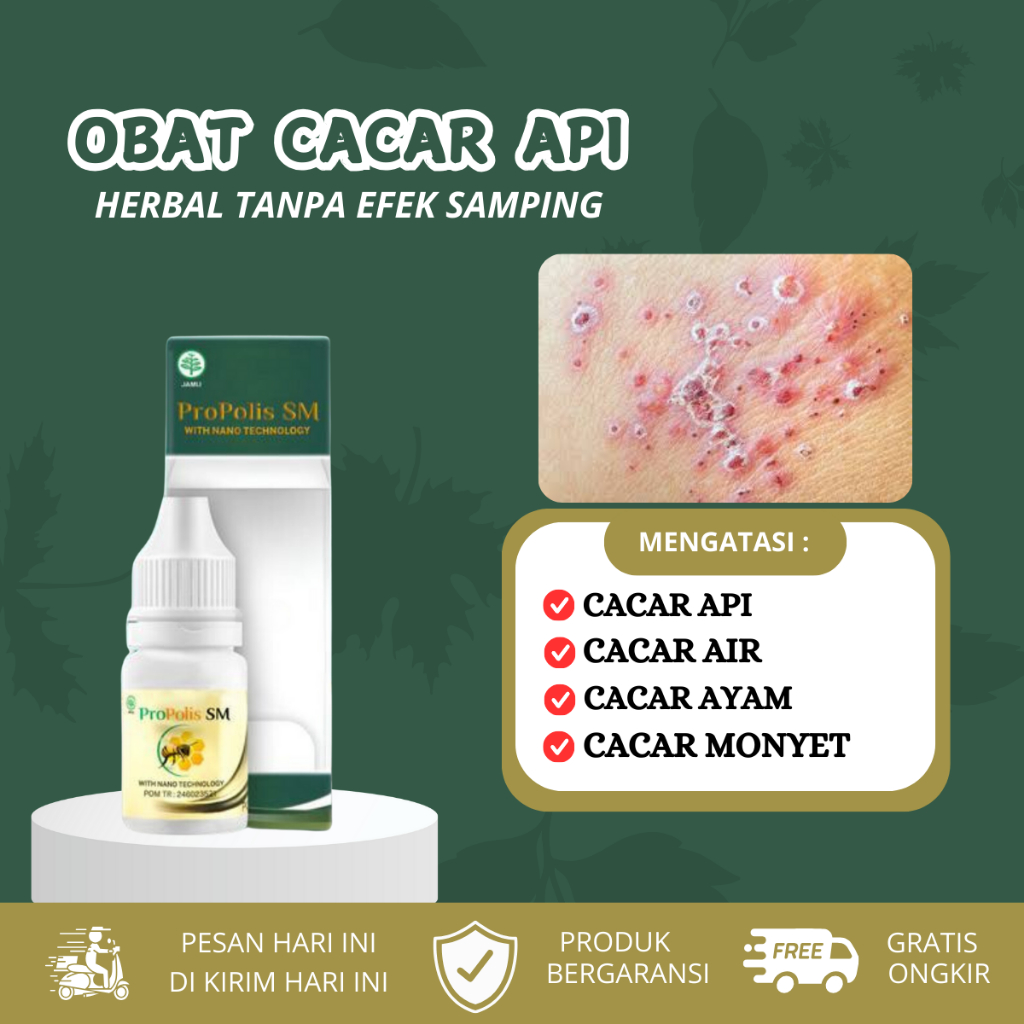Obat cacar api, cacar air, cacar ayam, cacar monyet, penghilang bekas cacar