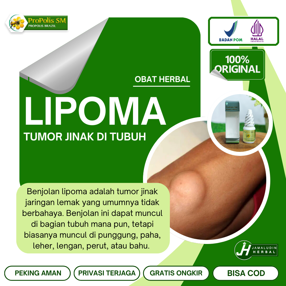 Obat Oles Untuk Menghilangkan Lipoma Pada Anak. Penghilang Benjolan Bengkak Di Paha / Selangkangan