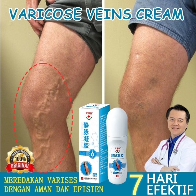 varises cream obat varises salep Obat Penghilang Parises Obat Kesemutan Salep obat varises paling am