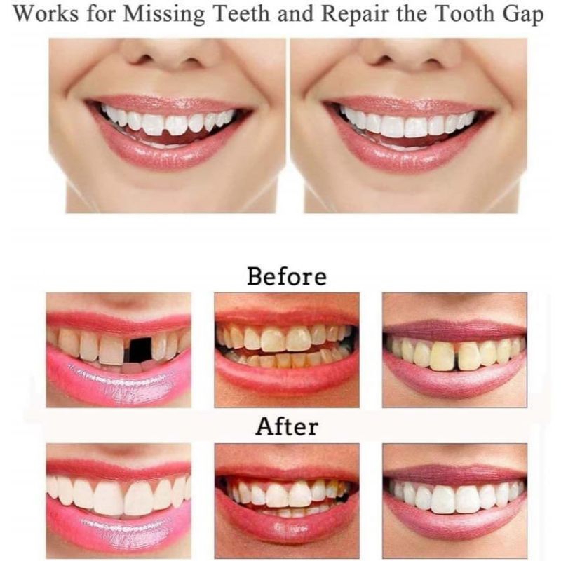 TEMPTOOTH / GIGI PALSU SEMENTARA / PENAMBAL GIGI PATAH RENGGANG/ PENAMBAL GIGI LEPAS PASANG