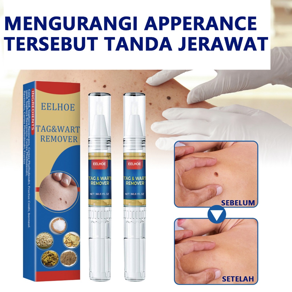 Krim Penghilang Tahi Lalat Kutil Ampuh EELHOE Tag & Wart Remover Pen Cream-XM0022