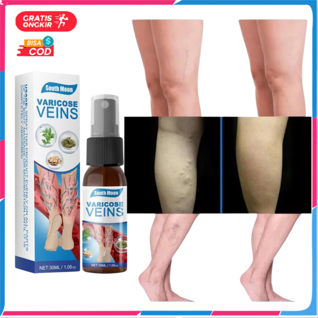 Obat Varises Spray Penghilang Varises Di Kaki Varicose Veins Spray Original Mengatasi Varises Cream 