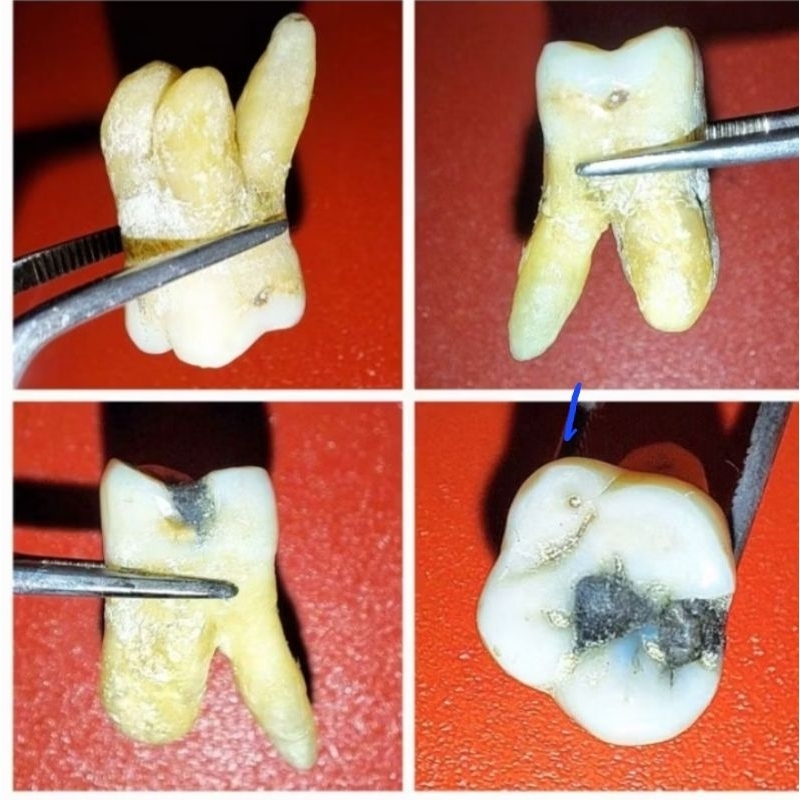 gigi asli praktikum/ gigi molar