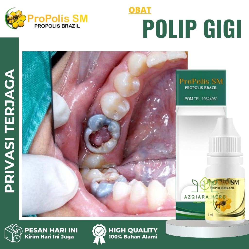 Obat Polip gigi, Obat Gusi Bengkak, Obat Abses Gusi, Obat Benjolan gigi, Obat polip pulpa gigi, Obat