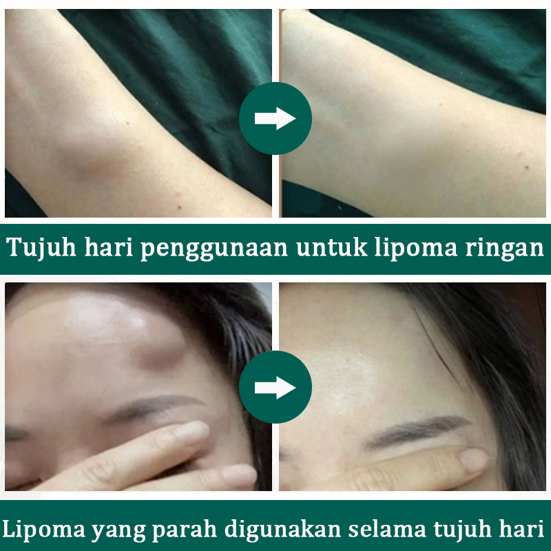 ISA Lipoma removal cream orinal Obat benjolan Lipoma cream orinal 20g salep benjolan lipoma lipoma