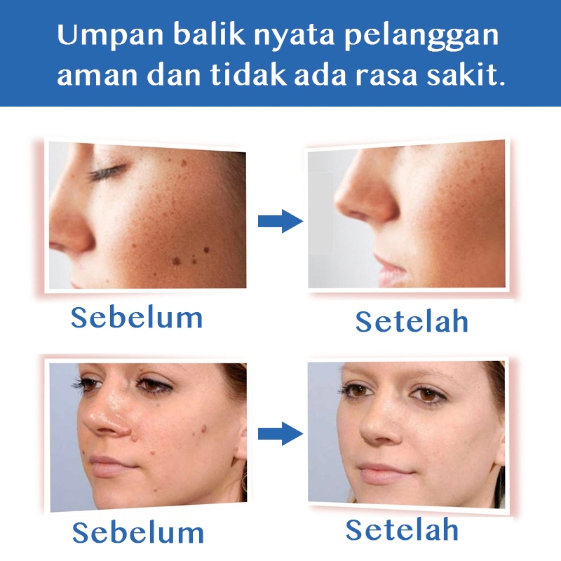 Penghilang tahi lalat penghilang tahi lalat di wajah obat penghilang tahi lalat penghilang tailat