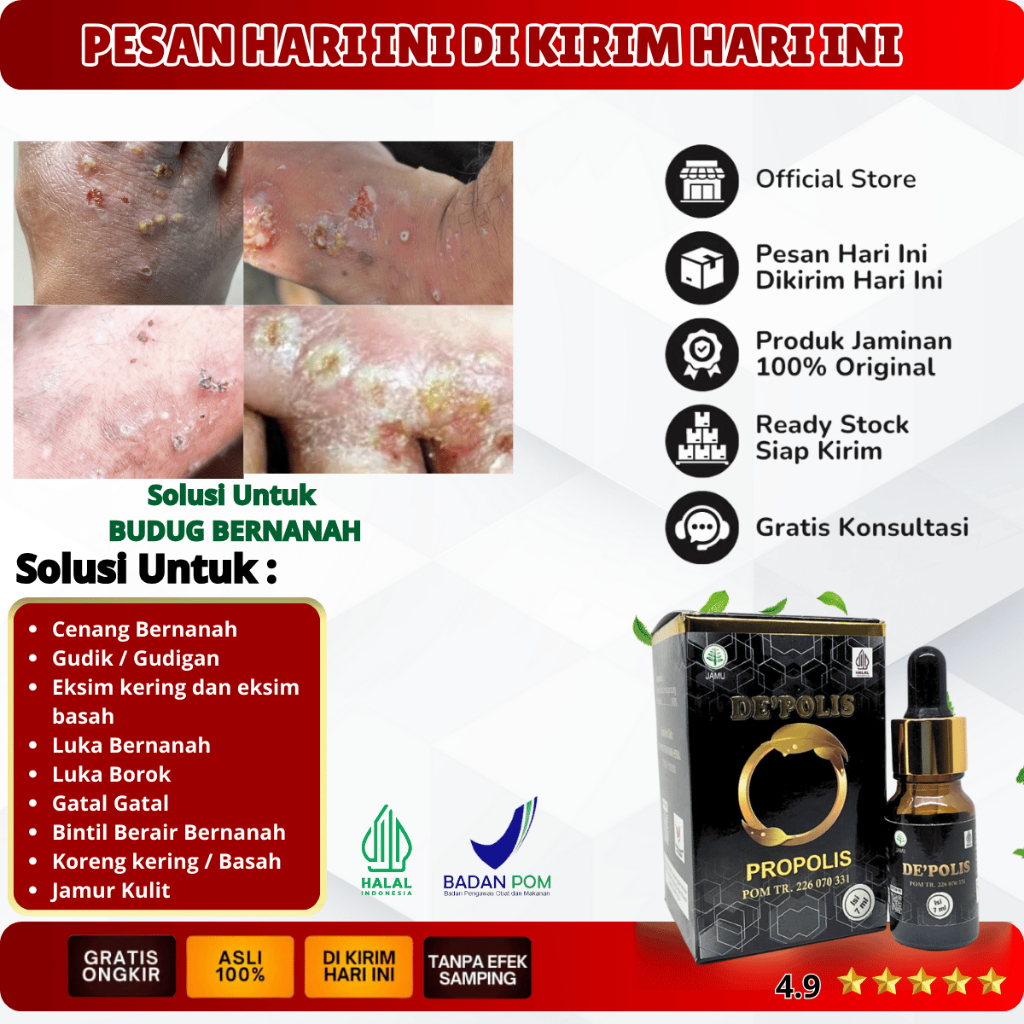 Obat Cenang Bernanah, Cenang Di Tangan, Cenang Di Kaki, Gatal Bernanah, Kulit Nanahan, Luka Borok Be