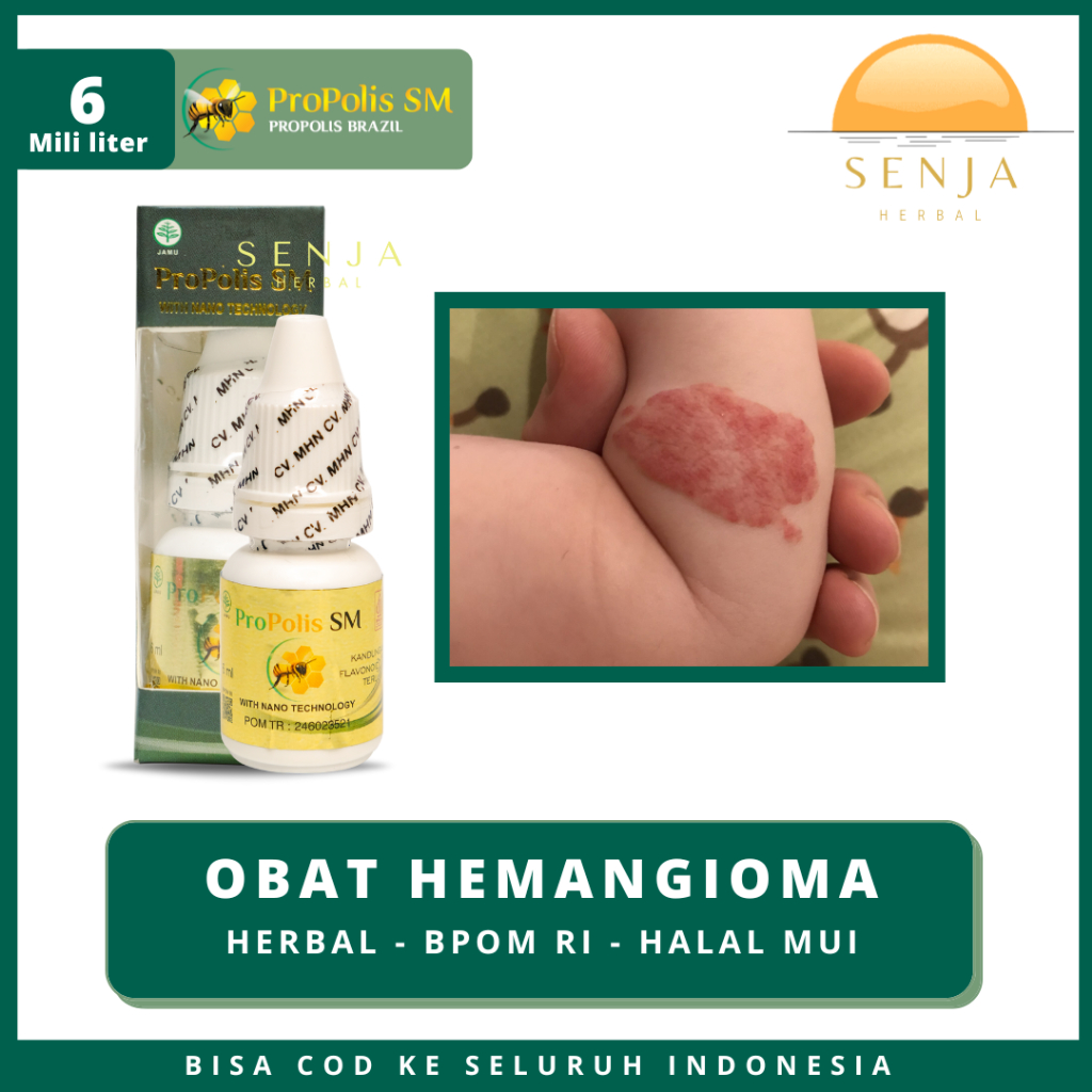 Obat Herbal Hemangioma Benjolan Kemerahan Pada Tubuh & Wajah Bayi Penghilang Hemangioma Bercak Merah