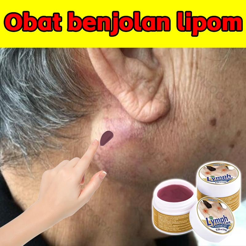 Lipoma cream original Obat benjolan Lipoma cream Lipoma removal cream original Salep lipoma salep be