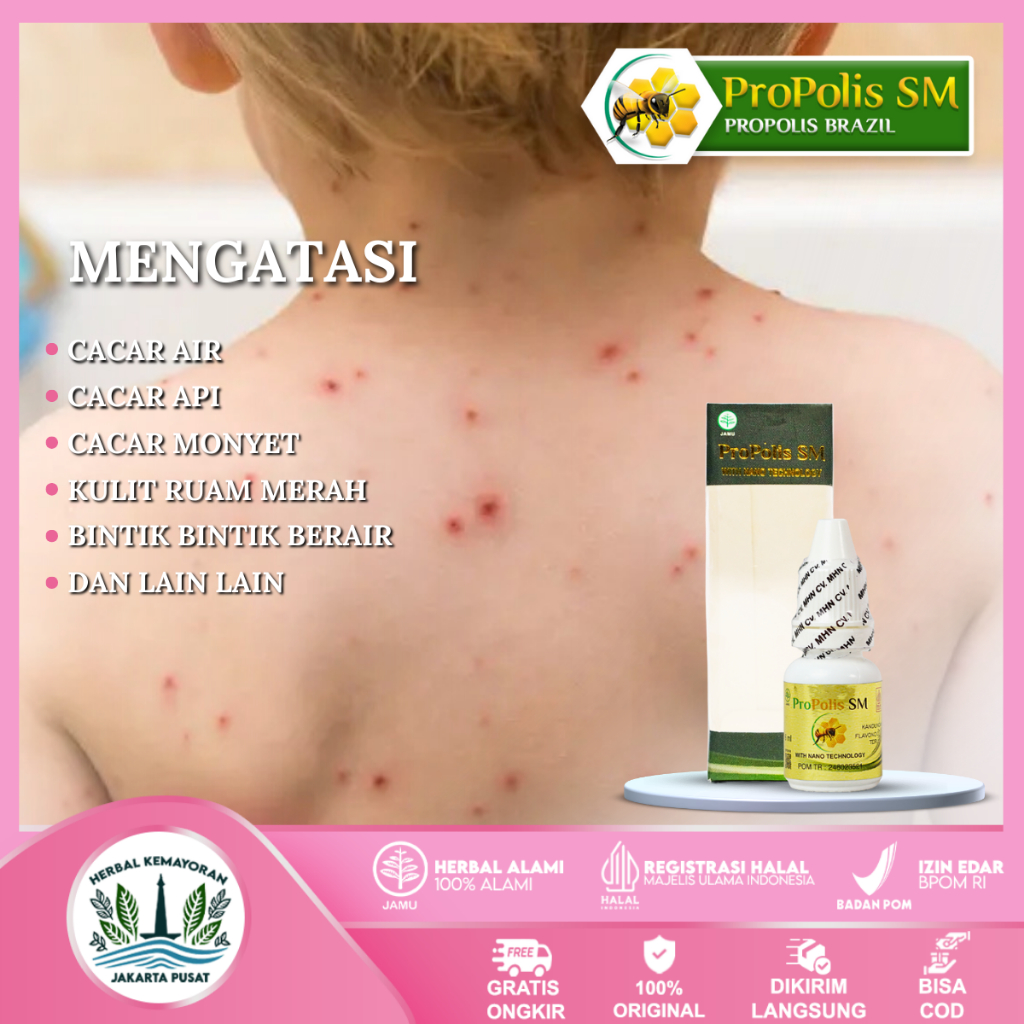 Obat Cacar Air Anak Obat Oles Cacar Air Cacar Api Ruam Merah Bintik Berair Penghilang Cacar Alami