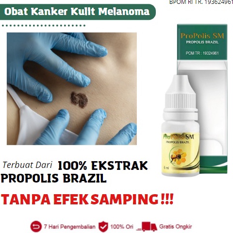 Kejar Surprise Obat Kanker Kulit Salep Kanker Kulit Melanoma Karsinoma Sel Basal Karsinoma Sel Skuam