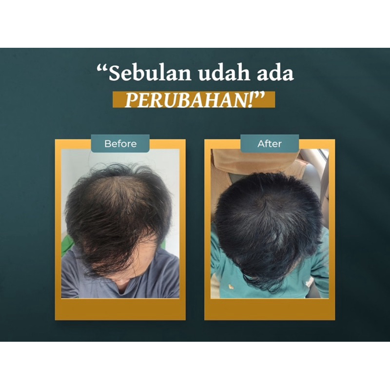 BEST SELLER TERMURAH TERLARIS KEMASAN BARU NEW PACK MINOXIDIL MADE IN ISRAEL COTSCO USA CANADA NORVI