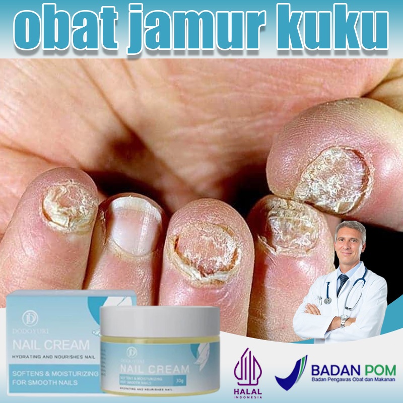 【BPOM】Obat jamur kuku obat kuku serum kuku 30g Obat jamur kuku tangan paling ampuh Jamur kuku Obat k