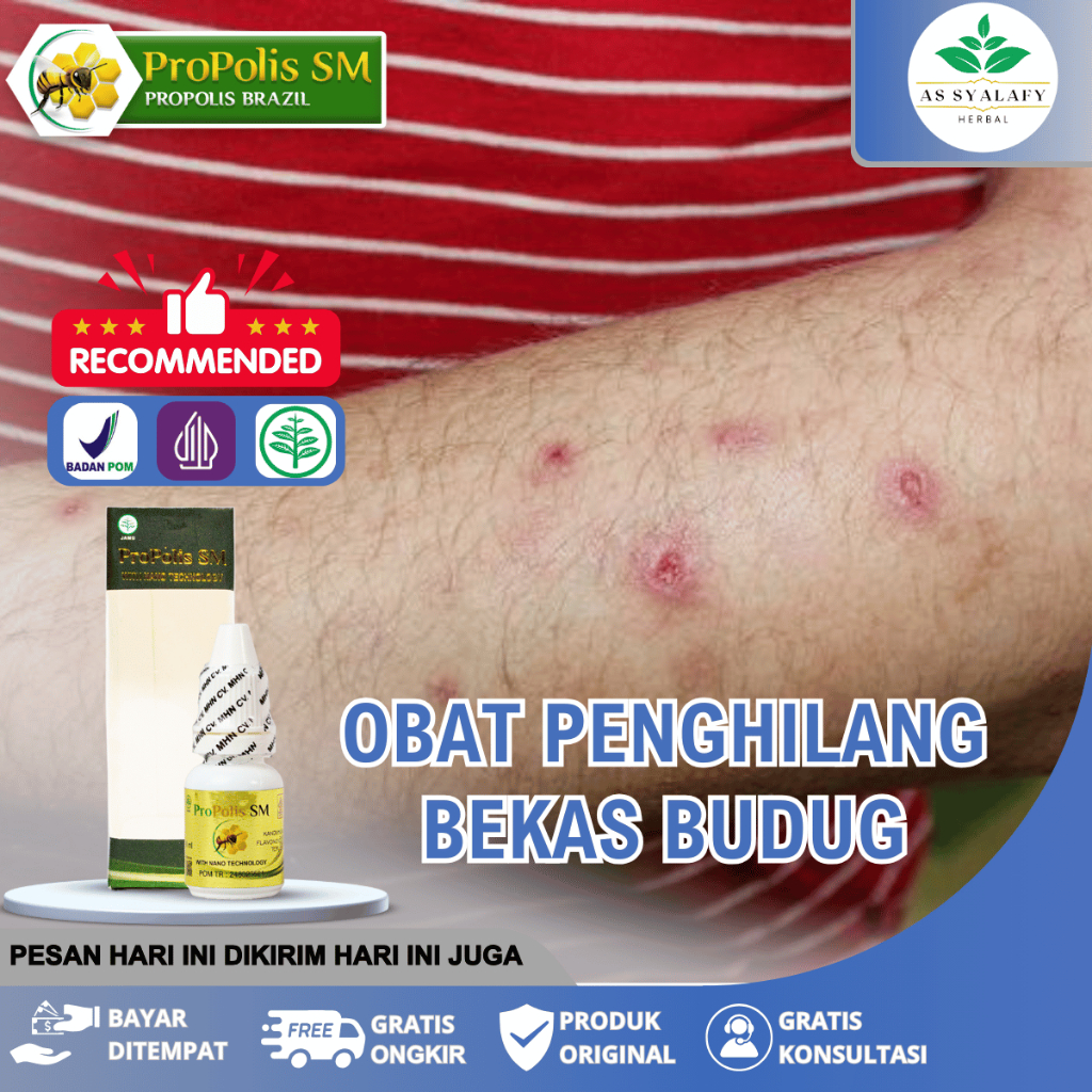 Obat Penghilang Bekas Budug Obat Scabies Obat Penghilang Borok Obat Tetes Penghilang Budug Bernanah