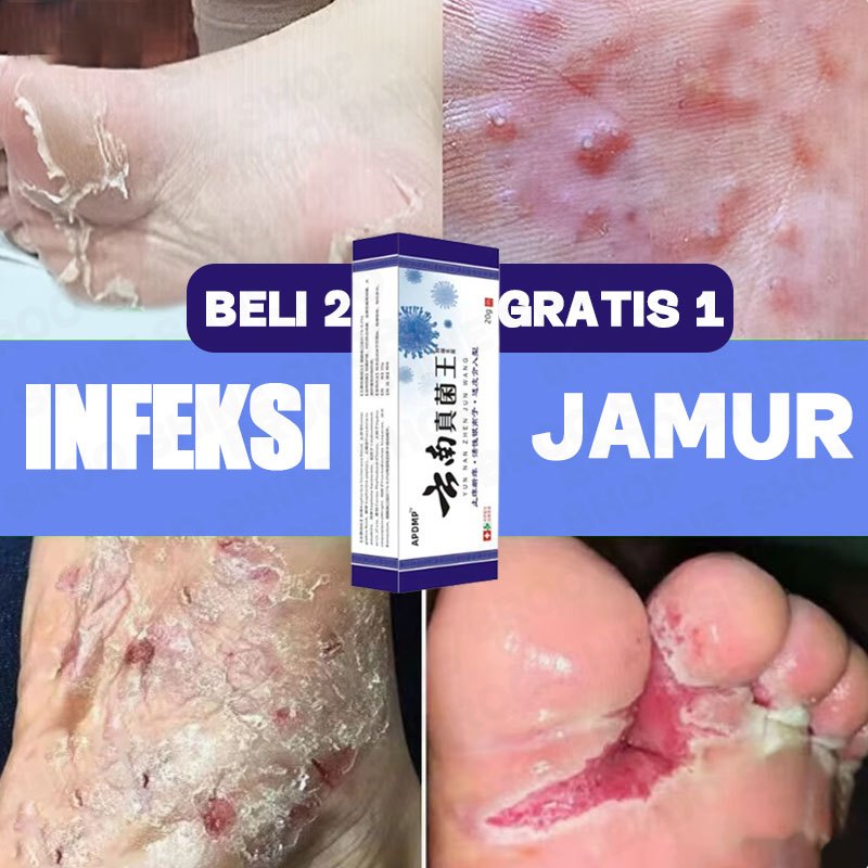 Obat Jamur Kulit Pecah Salep Gatel Obat Salap Kaki Bau Kaki Penghilang Bau Kaki Salep Kaki Obat Jamu